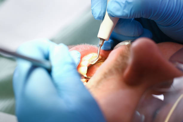Best Emergency Wisdom Teeth Removal in Alvin, TX